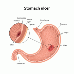 ulcer